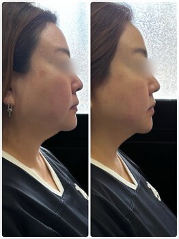 ドゥーソル 谷町四丁目店(due sole)/谷四/レモンボトル2cc