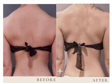 リルプラス(LiLL+)の雰囲気（慢性的な肩こりには筋膜リリースがオススメです^^）