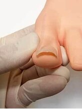 牛久巻き爪センター/3. 持上げ準備