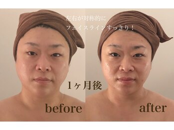 ラ フルール 折尾店/小顔矯正コルギ before→after