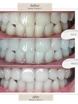 シエル スラン(Ciel Serein)/セルフホワイトニング