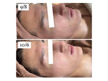 ホワイトアクア つくば店(WHITE AQUA)/ハーブピーリング/毛穴/つくば