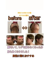 アイルハイパースキン/メンズ脱毛ヒゲ青剃り解消