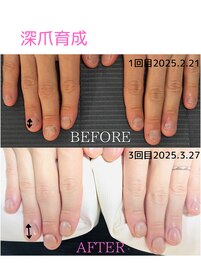 深爪育成3回目自爪風