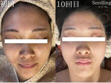 シードリン(Seedling)/フェイシャル×ボディ　60分