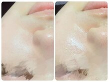 トータルビューティ ノイド(Noid)/毛穴洗浄　全顔