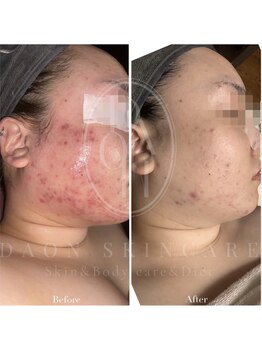 多穏スキンケア(skin care)/ニキビケア