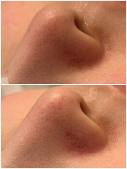 メゾンリュバン 天王寺(Maison Ruban)/毛穴洗浄|毛穴ケア