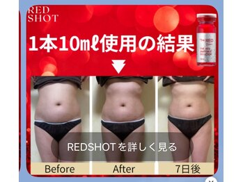 ビユー エスティカ オリエンタル 伊勢崎店(BIYU ESTETICA ORIENTAL)/韓国脂肪分解