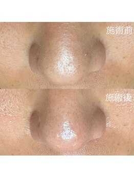 エクラ バイ シャンリィ(eclat by shanLy)/毛穴洗浄!