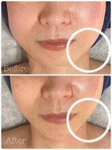 トゥモロー(TOMORROW)/即リフトアップ・即小顔