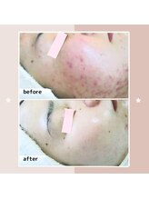 レゾン 京橋店/【ビフォーアフター】ニキビケア