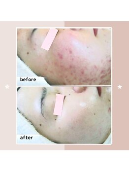 レゾン 京橋店/【ビフォーアフター】ニキビケア