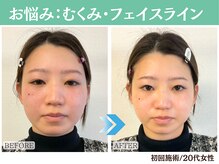 ナチュラルビューティーフェイス 横浜(NBF)/むくみ・フェイスライン / 20代