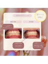 プラスビー 2号店(+b)/ホワイトニングビフォーアフタ