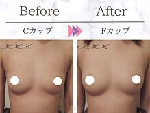 メディカルサロン エム エム エム 大阪梅田グランドサロン(M.M.M)/【バストアップ例】　C→Fカップ