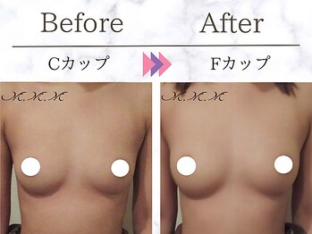 メディカルサロン エム エム エム 大阪梅田グランドサロン(M.M.M)/【バストアップ例】　C→Fカップ
