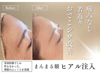 ビエン 福岡古賀(BiEN)/【ふっくらおでこに】額のシワへ