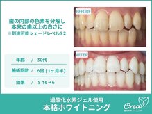 クレア(Crea)/【ホワイトニング症例写真】