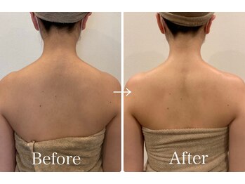 エニ 恵比寿(eni)/肩周りのビフォーアフター