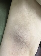 ナノハナ/鹿沼市全身脱毛ナノハナ