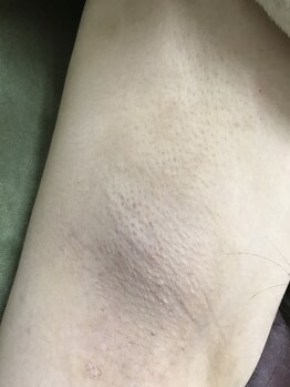 ナノハナ/鹿沼市全身脱毛ナノハナ