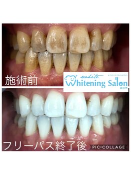 ホワイトニングサロン 四日市white/茶渋汚れもごっそり綺麗に♪