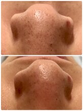 サラモ(Sa La Mo)/ハイドラピーリング　毛穴の洗浄