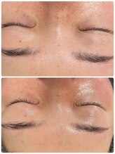 サロンドエテ(salon de ete)/毛穴の汚れ1発撃退