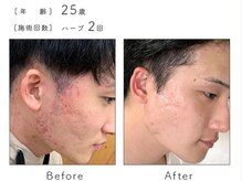 チップ(chip)/25歳／施術2回