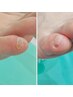 副爪2ヵ所（小指の爪横にある爪ではないもの）＋爪切りセット¥8,250→ ¥6,600