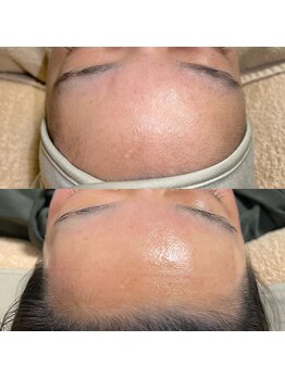 ブレデ フクオカ(B’lady Fukuoka)/つるんとしたおでこ作り♪