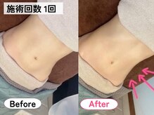 ハロ(Halo)/腸もみ施術