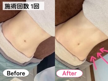 ハロ(Halo)/腸もみ施術