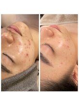 ジャドール ネイルアンドアイラッシュ(J'ADORE)/ハーブピーリング　3回コース