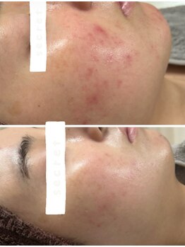 チュチュ(TUTU)/肌荒れもここまで改善