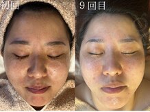 シードリン(Seedling)/ララピール