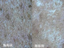 キーオブフェイス(Key of Face)/お悩み【毛穴が匂う・ベタつく】