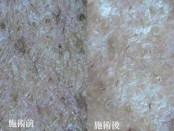 キーオブフェイス(Key of Face)/お悩み【毛穴が匂う・ベタつく】