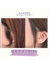 ベベ(Bebe)/もみあげ脱毛♪