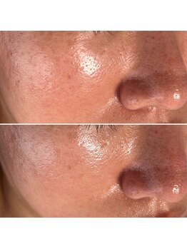 エタビー(etebe)/毛穴洗浄