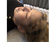 アロエベル(aloe Belle)/美容鍼