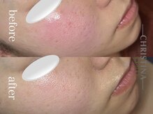 イデアル(Ideal)/赤みの鎮静が得意♪¥9900～