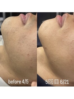 メンズー(MENZOO)/