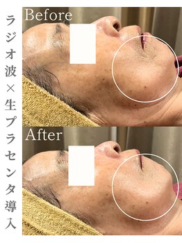 シストワ(sistoi)/70代のお客様☆口元のたるみ改善