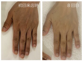 キレイテ 上野店/40代/8回目【ハンドケア上野】