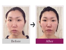 ビコツゼロ 青山(BIKOTSU ZERO)/小顔・頬骨の歪み・顎の歪み