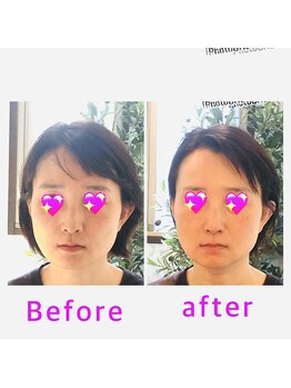 エンドリングフェイシャル専門サロン ムーンティア/エンドリングフェイシャル小顔