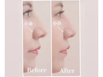 ラプリ 福岡博多店(Raplit)/隆鼻+輪郭・小顔矯正 美鼻/小顔