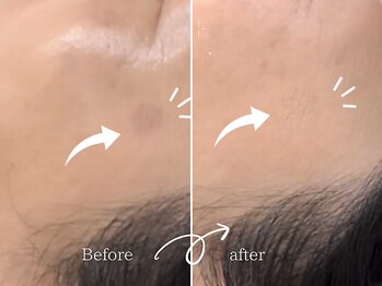 レディゴー(LADY GO)/コンシーラーで色素をカバー